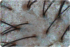 Outer scalp, Before and After Treatment on Scalp