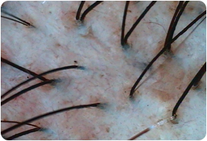 Stratum basal, Before and After Treatment on Scalp