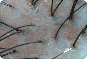 Stratum corneum, Before and After Treatment on Scalp
