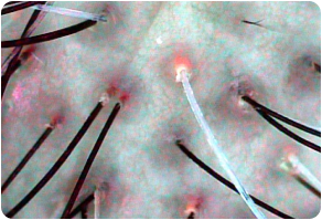 Sebum, Before and After Treatment on Scalp