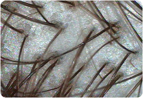 Outer scalp, Before and After Treatment on Scalp