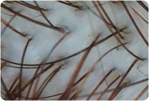 Stratum basal, Before and After Treatment on Scalp