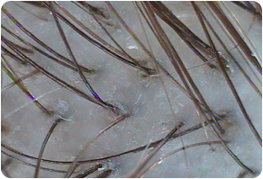Stratum corneum, Before and After Treatment on Scalp