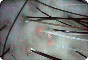 Sebum, Before and After Treatment on Scalp