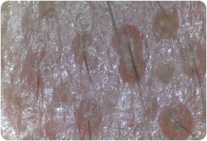 Outer scalp, Before and After Treatment on skin