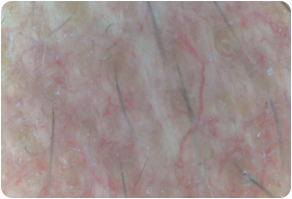 Stratum basal, Before and After Treatment on skin
