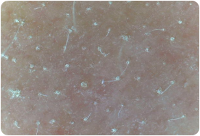 Stratum corneum, Before and After Treatment on skin