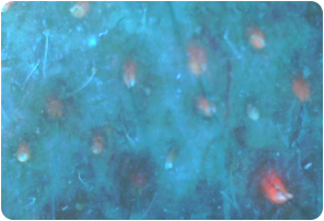 Sebum, Before and After Treatment on skin