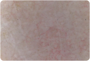 Stratum basal, Before and After Treatment on skin