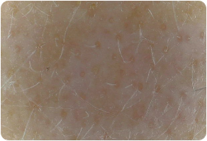 Stratum corneum, Before and After Treatment on skin