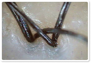 After Treatment 1